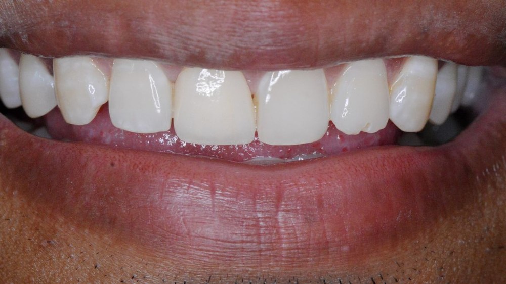 Dental treatment result at Dr. Pranay's Dental Clinic in Noida