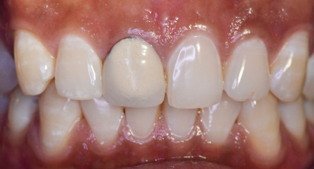 Patient dental result from Dr. Pranay's Dental Clinic in Sector 52, Noida