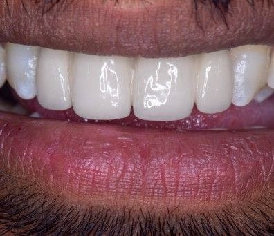 Dental rehabilitation result at Dr. Pranay's Dental Clinic