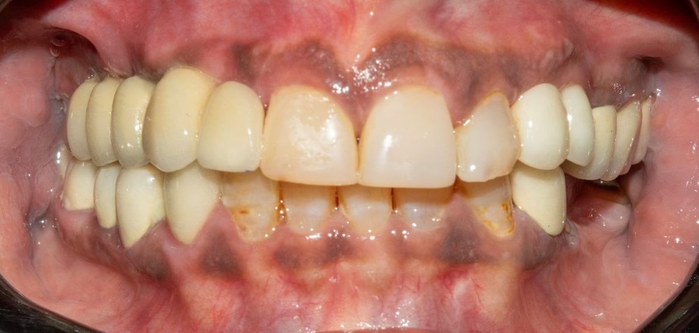 Prosthodontic treatment result at Dr. Pranay's Dental Clinic