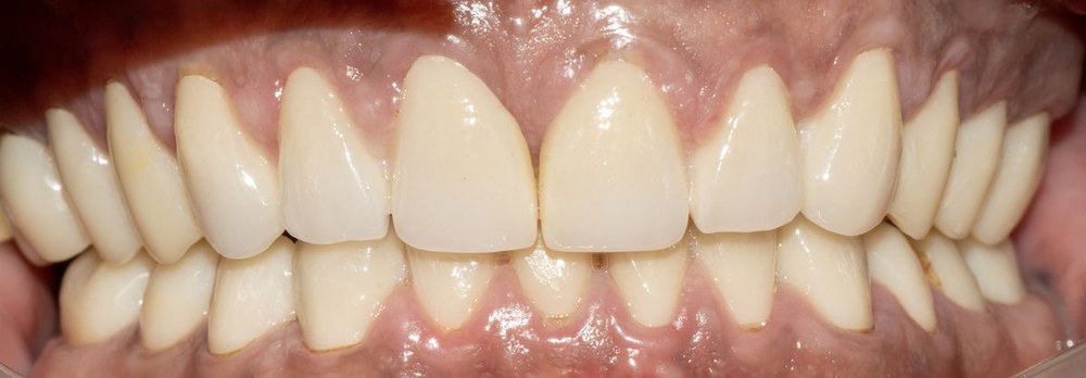 Dental treatment outcome at Dr. Pranay's Dental Clinic in Noida
