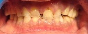 Patient smile result at Dr. Pranay's Dental Clinic