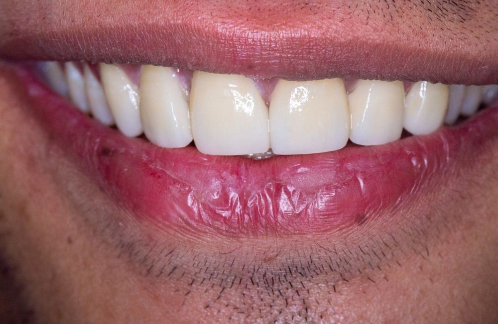 Dental restoration result at Dr. Pranay's Dental Clinic