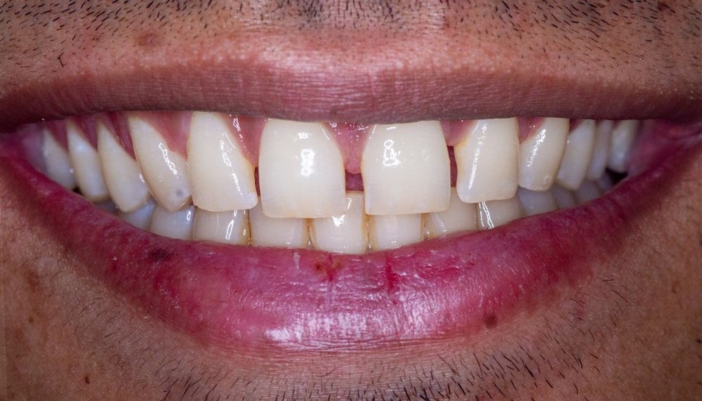 Prosthodontic result at Dr. Pranay's Dental Clinic in Noida