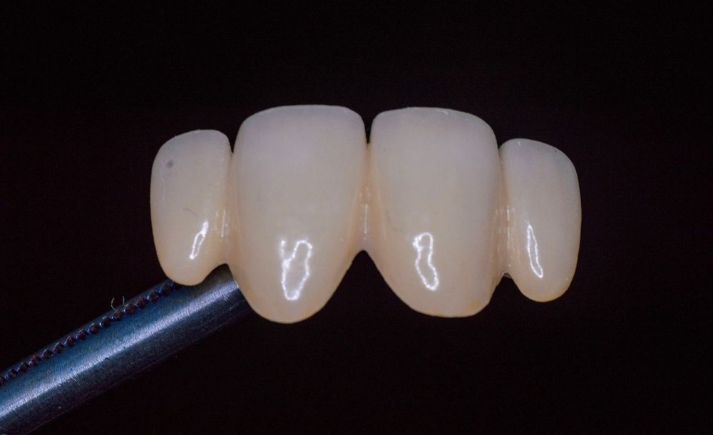 Dental care result from Dr. Pranay's Dental Clinic