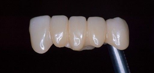 Patient dental result from Sector 52 dental clinic