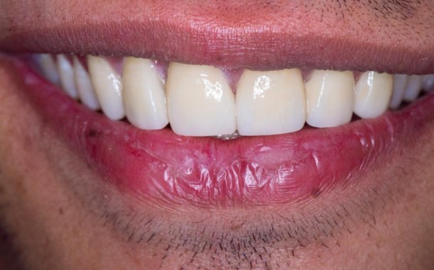 Real patient smile result at Dr. Pranay's Dental Clinic